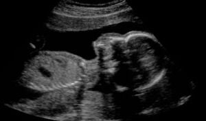 package3_4DUltrasound_Knoxville